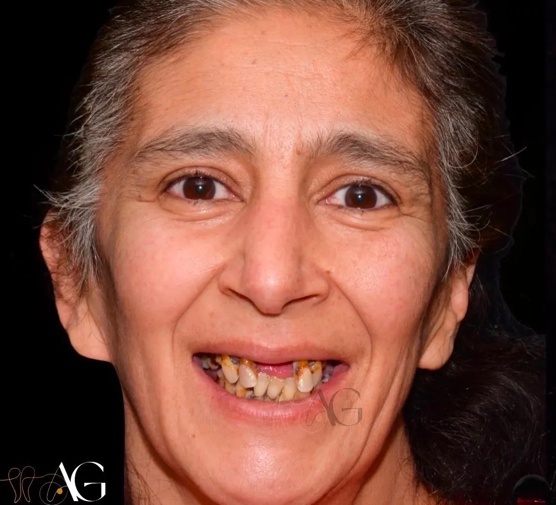 Antes del tratamiento: Rehabilitación oral completa