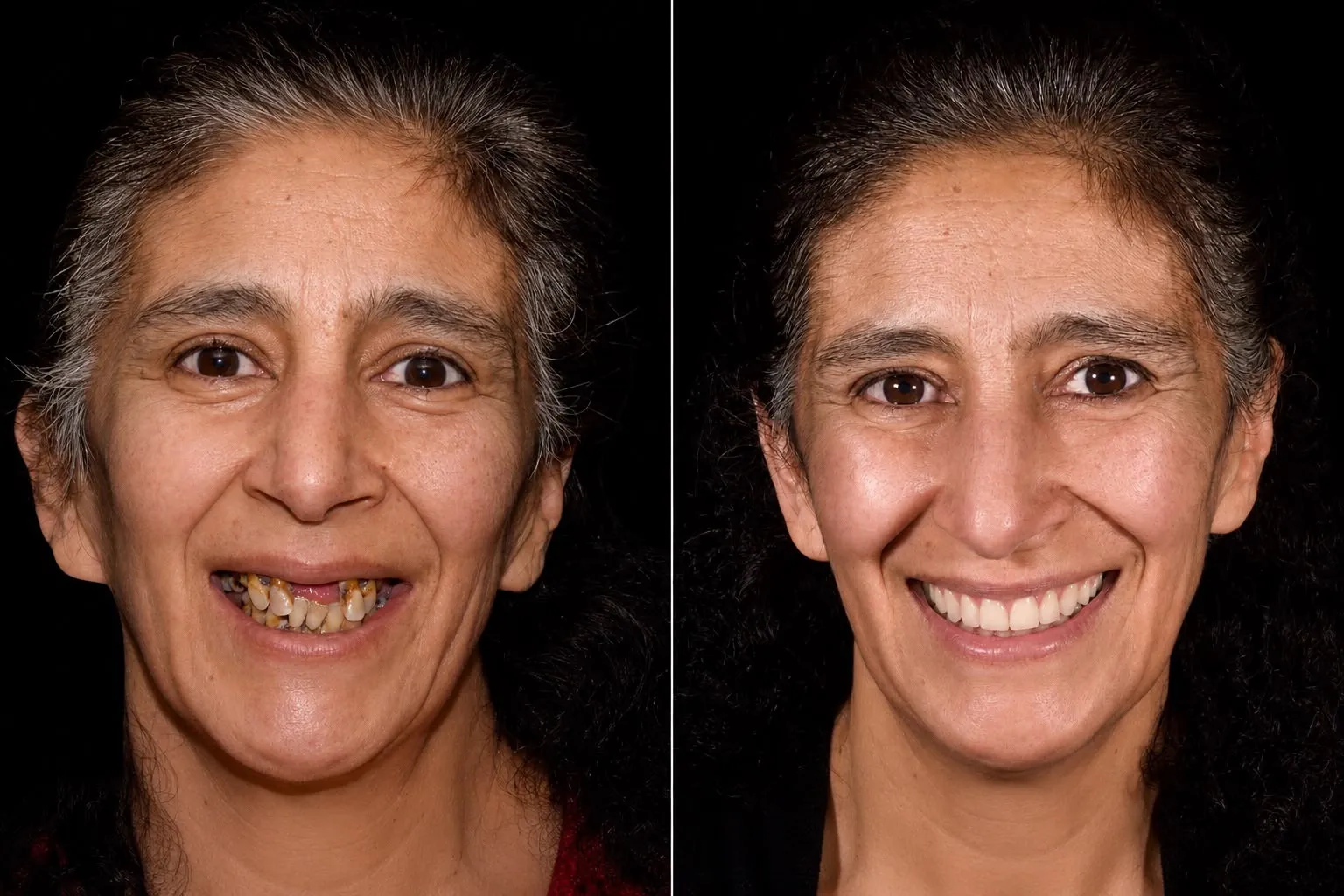 Resultado de implantes dentales