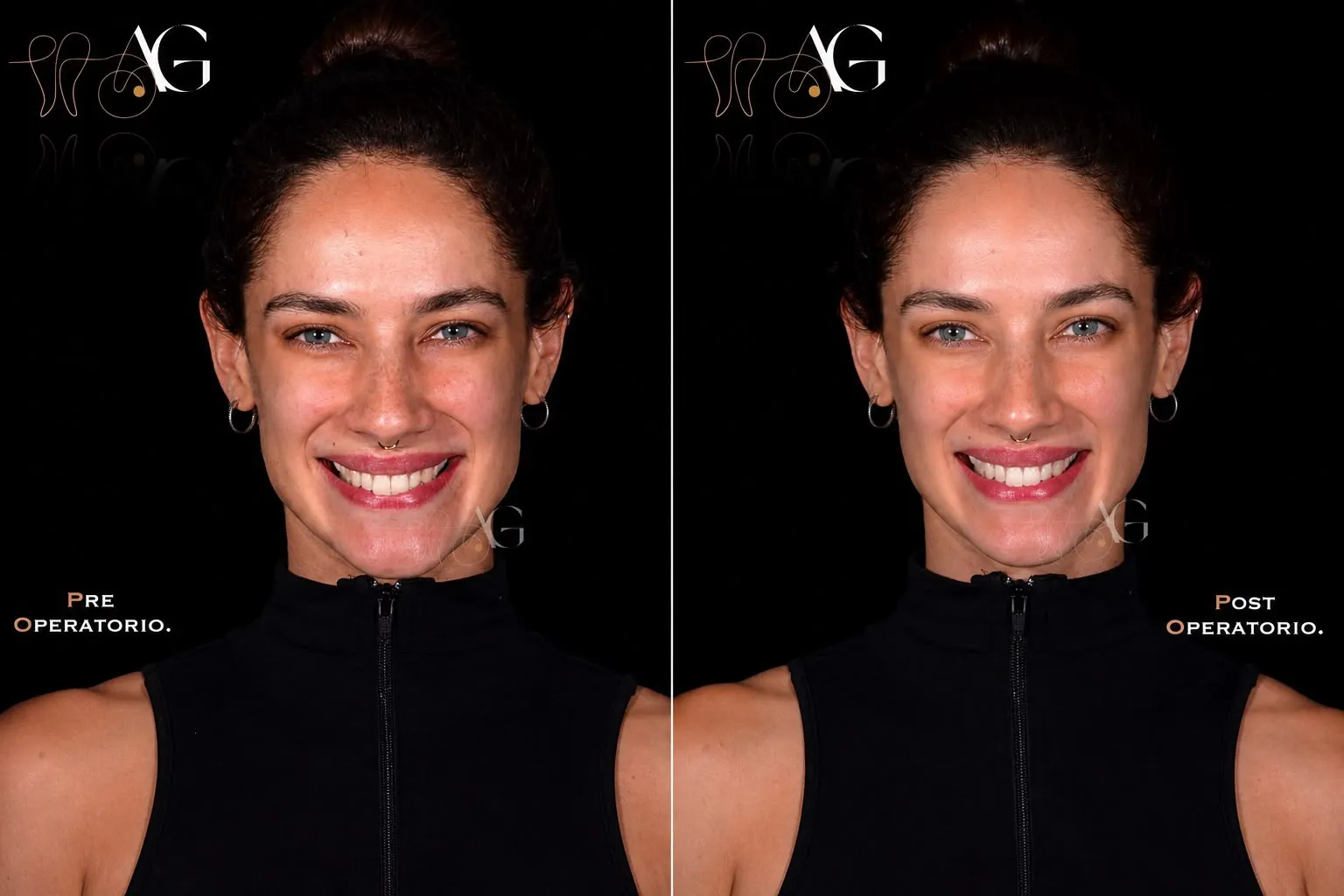 Comparativa preoperatoria y postoperatoria de un diseño de sonrisa